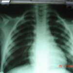 chest xray