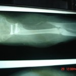 tibialization of fibula
