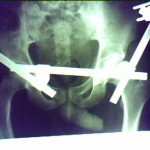 fracture after 2 months