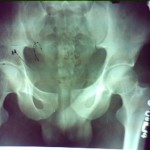 pubic sympasis diastasis