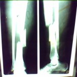 photo_110608_006 open segmental tibia fracture