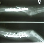 p10100181 humerus nonunion with bent plate