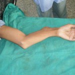 7 year old nonunion humerus old nonunion humerus treated with Illizarov Fixator