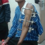dsc06829 humerus nonunion treated with Illizarov fixator