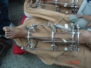 dsc06832 day 60 of limb lengthening