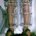 image041 8 month pic of cosmetic limb lengthening