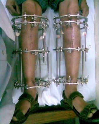 1950s in Russia for veterans that had developed unusual leg fractures