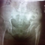 neglected 50 yr old dislocation of left hip