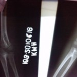 p160310_1208 proximal radio-ulnar synostosis