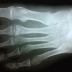 Frieberg`s disease